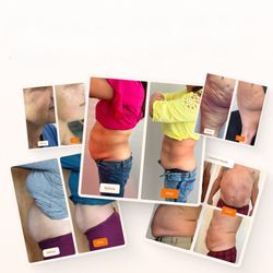 Lexington Laser Like Lipo