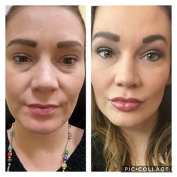 American Academy of Facial Esthetics - Before and after
