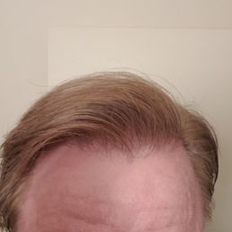 my hair after 3 Dr. McAndrews procedures my hair after 3 Dr. McAndrews procedures