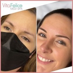 Vita Felice Medi Spa - Powder brows before and after