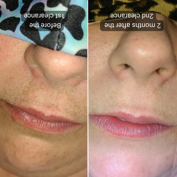 TS Electrolysis - Upper lip hair removal with electrolysis - Hair Removal Near Me - Vancouver, Washington TS Electrolysis - Upper lip hair removal with electrolysis - Hair Removal Near Me - Vancouver, Washington