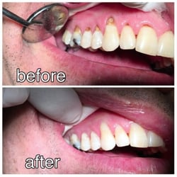 Just Dental - Actual Patient . . . Before & After Bonding