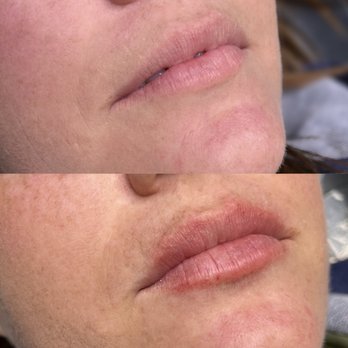 Timeless Glow - Lip fillers - Permanent Makeup Near Me - National City, California Timeless Glow - Lip fillers - Permanent Makeup Near Me - National City, California