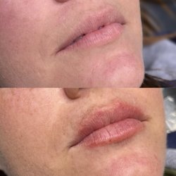 Timeless Glow - Lip fillers