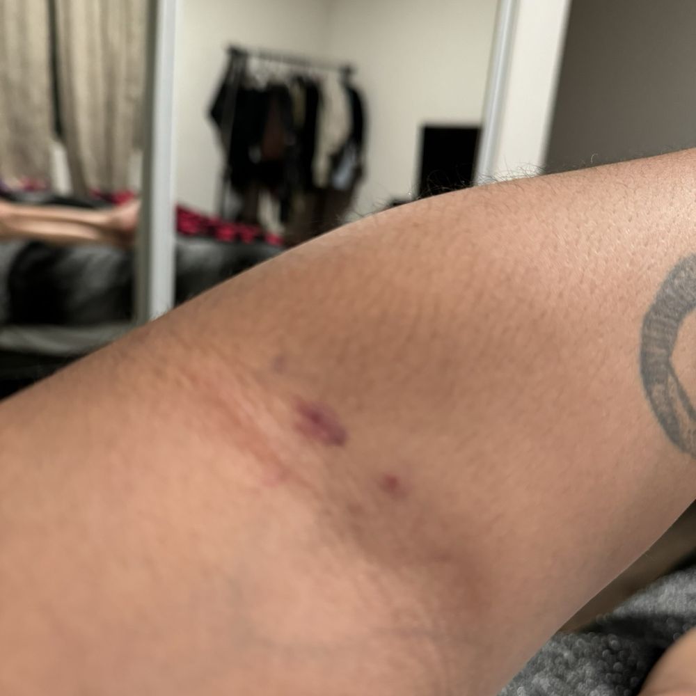 Behnoush Zarrini, MD - Bruises from needles - Pain Management Near Me - Beverly Hills, California Behnoush Zarrini, MD - Bruises from needles - Pain Management Near Me - Beverly Hills, California