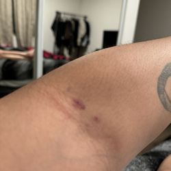 Behnoush Zarrini, MD - Bruises from needles