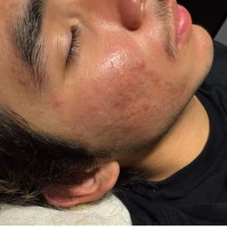 Skin Goddess Spa - March 2025 Acne Free
