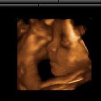 Mirror Imaging Ultrasound - Ultrasound shot from website - Health & Medical Near Me - Cincinnati, Ohio Mirror Imaging Ultrasound - Ultrasound shot from website - Health & Medical Near Me - Cincinnati, Ohio