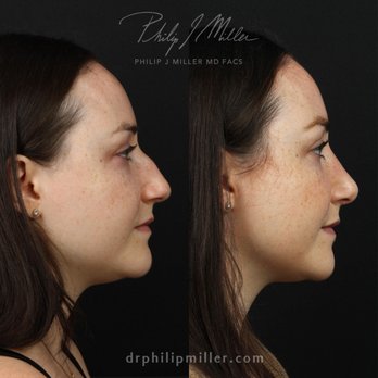 Gotham Plastic Surgery - Rhinoplasty and fat grafting. - Cosmetic Surgeons Near Me - New York, New York Gotham Plastic Surgery - Rhinoplasty and fat grafting. - Cosmetic Surgeons Near Me - New York, New York