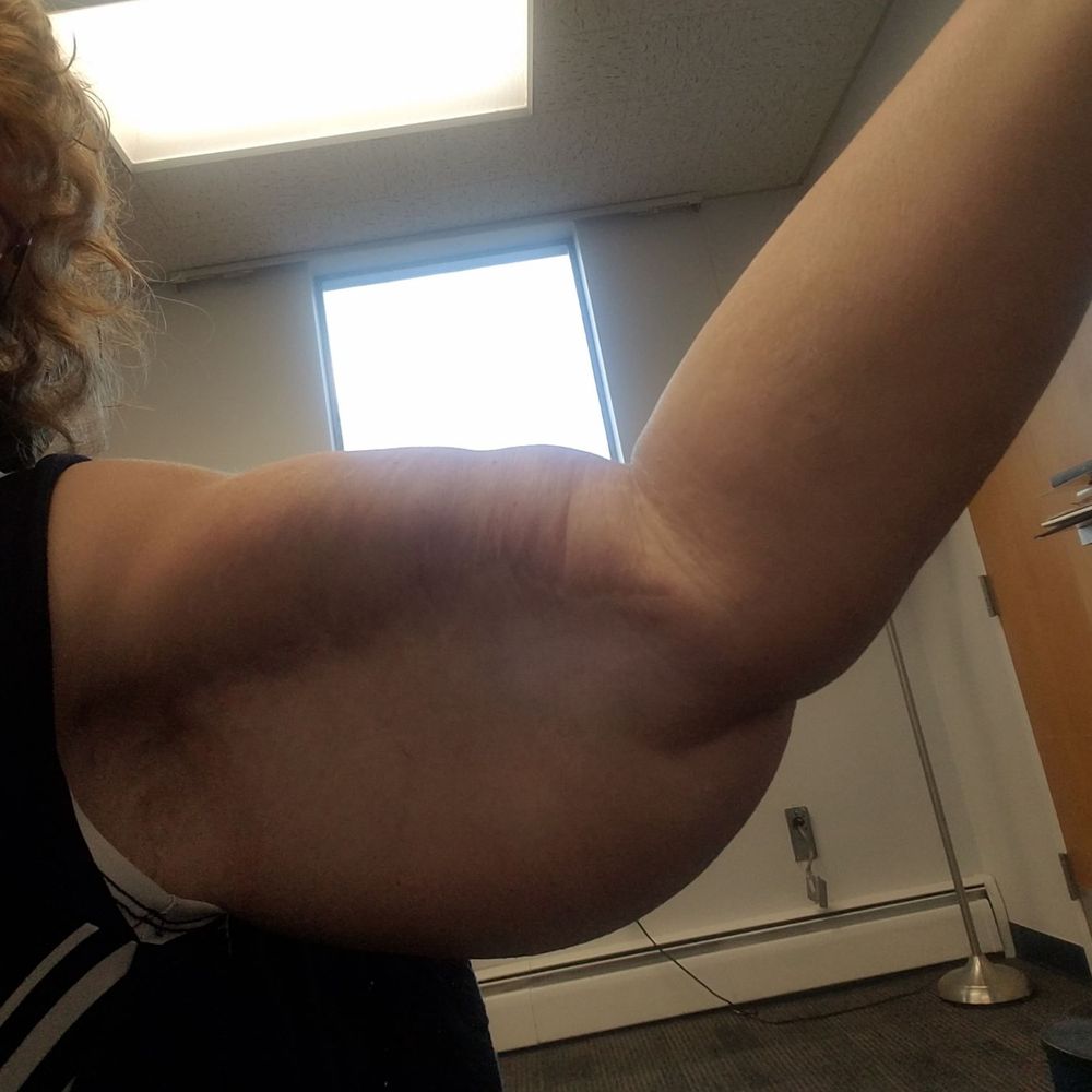 CosMed - Arm, 10 years later. I work out 3- 4x a week. - Cosmetic Surgeons Near Me - Tijuana, BCN