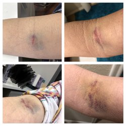 Labcorp - I have never ever been bruised like this I have been stuck up to 6 times by several people but no I've never been bruised like this