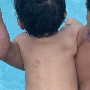 Kidtown Las Vegas - Photo of my sons bite marks which they didn't even ask to see. - Preschools Near Me - Las Vegas, Nevada