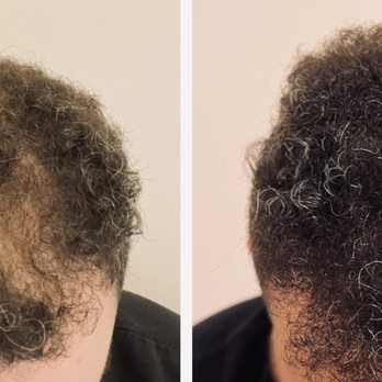 Barber Surgeons Guild - Hair Loss Centers Near Me - West Hollywood, California