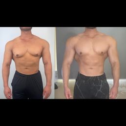 Before surgery (left), and after 3 months post-op (right). Before surgery (left), and after 3 months post-op (right).