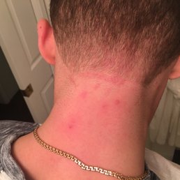 Thanks for the scalp fungus...5 weeks later... Thanks for the scalp fungus...5 weeks later...