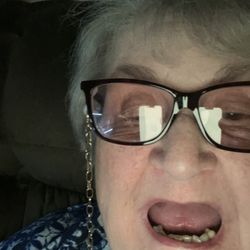 Derry Dental Associates - I was unable to lift my front lip to show the absence of teeth.