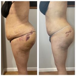 Real MLD - This client had a bbl + lipo 360, she had 4 sessions in 7 days and as you can see her swelling drastically decreased.