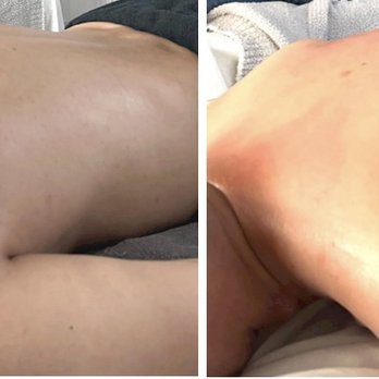 G Beaut Bar - Brea - mid-back curvature side view - Skin Care Near Me