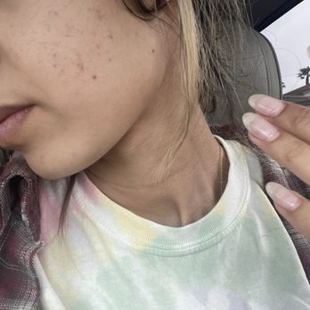 Solutions Skin Care By Kimberly - 3rd process picture (getting clearer with each visit) - Skin Care Near Me - Costa Mesa, California