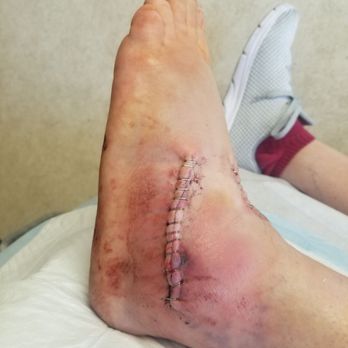 Baumgarten Morris MD - Can't wait to walk on this foot. - Surgeons Near Me - Duarte, California Baumgarten Morris MD - Can't wait to walk on this foot. - Surgeons Near Me - Duarte, California
