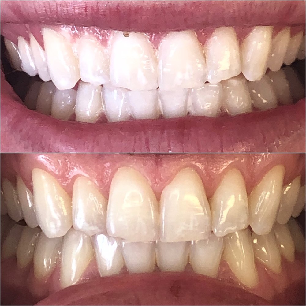 Illuminate Teeth Whitening Logo