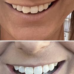 WestSide Dental Studio - Before & After of my chipped tooth. THANK YOU Dr Dean!
