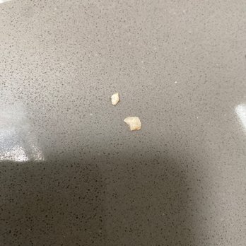 Garces Dental Group - 2 of the 4 fillings that failed in under 2 years  Poor dentistry - General Dentistry Near Me - Philadelphia, Pennsylvania