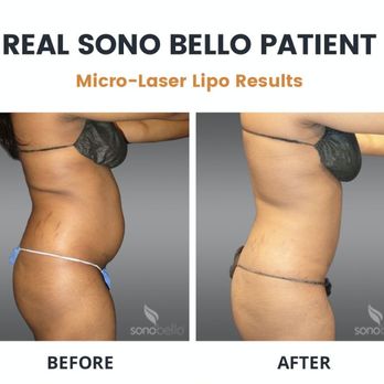 Sono Bello - Cosmetic Surgeons Near Me - Raleigh, North Carolina Sono Bello - Cosmetic Surgeons Near Me - Raleigh, North Carolina