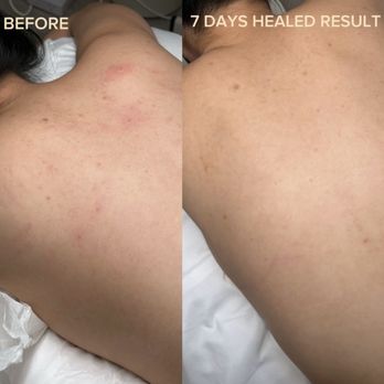 Ambers Esthetic - Microneedle 1 session - Eyelash Service Near Me Ambers Esthetic - Microneedle 1 session - Eyelash Service Near Me