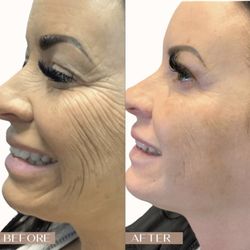 Envisage Med Spa - MORPHEUS8 combines micro needling with radio frequency to transform your skin. As we age, our skin begins to lose elasticity, wrinkles and l