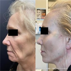 Dream Aesthetics Medspa - Sculptra and PDO threadlift
