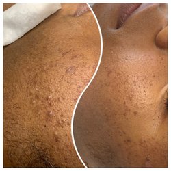 SP Wax & Skin Care Studio - Before and After - Detox Facial. A treatment intended to detoxify the skin from congested pores. Treat acbeiv skin.