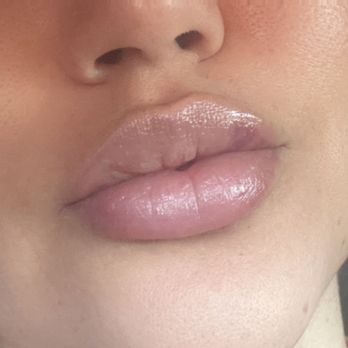 Self Care Lounge - Lip filler by Trisa! - Medical Spas Near Me - Covina, California