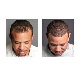 Hair Transplant Newton Massachusetts