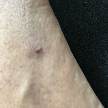 Cape Fox Lodge - I think a Bed bug bite - Hotels Near Me - Ketchikan, Alaska