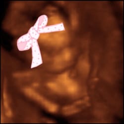 Prenatal Ultrasound of Glendale - Our little girl at 20 weeks (bow not included)