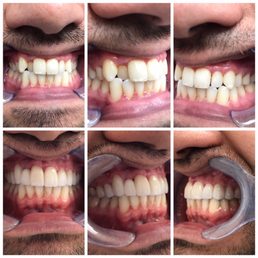 My before and afters. Picture taken right after. They look even better now My before and afters. Picture taken right after. They look even better now