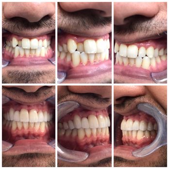 Asal Sedghi, DDS - My before and afters. Picture taken right after. They look even better now - Cosmetic Dentists Near Me - Los Angeles, California Asal Sedghi, DDS - My before and afters. Picture taken right after. They look even better now - Cosmetic Dentists Near Me - Los Angeles, California