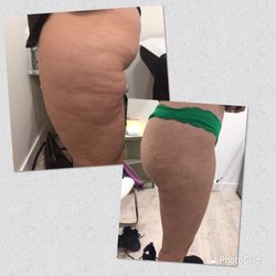 Decoris Aesthetics - Body Contouring treatment;helps reduce fat and tighten skin . It's the best treatment for cellulite