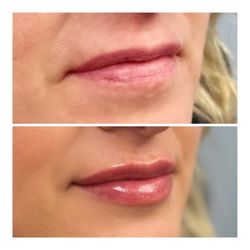 Pure Elements Medical Spa - Before and after