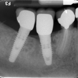 Robert C Goldtrap DDS - Implants replacing missing tooth