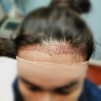 Dustin Z Zeng, MD - hair restoration - Internal Medicine Near Me Dustin Z Zeng, MD - hair restoration - Internal Medicine Near Me