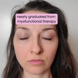 Oral Posture Orofacial Myofunctional Therapy - Nearly graduated from myofunctional therapy. Much more symmetry!