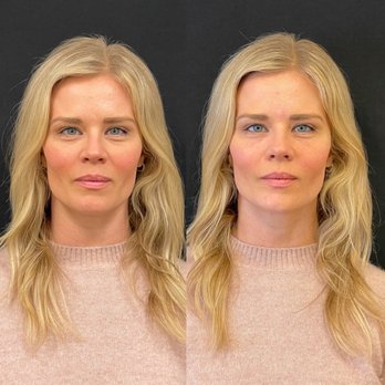SkinSpirit - Before and after for under eye filler - Skin Care Near Me - Newport Beach, California SkinSpirit - Before and after for under eye filler - Skin Care Near Me - Newport Beach, California