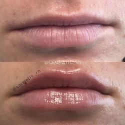 Stunning Results! Before and After Lips done by Me.