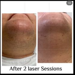 Dee's Laser & Medspa - Chin - laser hair removal