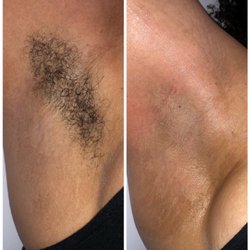 Sala Aesthetics - Before and After Underarm Wax