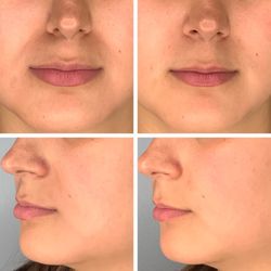 Hanami Medspa : Elaine Phuah, DO, MBA, FACOI - Nasolabial folds PRF filler