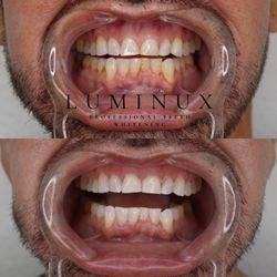 Luminux Professional Teeth Whitening