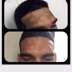 Moran Laser And Salon - 5 previous treatments from another clinic with no results but scarring. 1 treatment with Jason Moran.